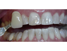 Zoom whitening treatment