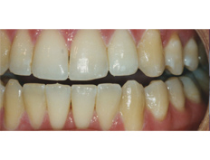 Teeth bleaching